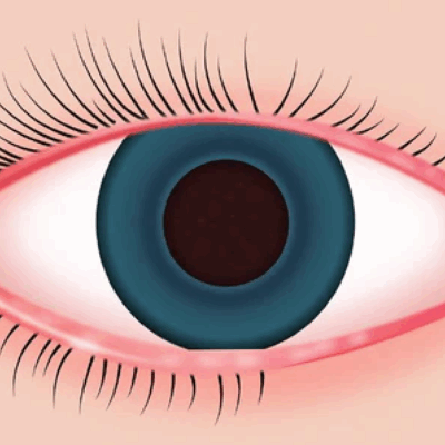 Blepharitis Wimpernverlängerung